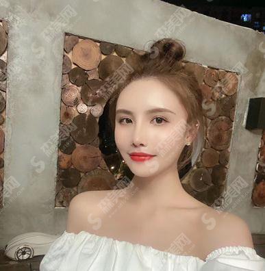 河北省二院整形美容科价目表2021,内含自体肋软骨隆鼻术后恢复分享