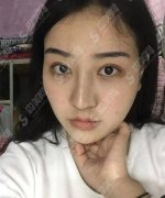 湘雅医院整形科价目表2021，附吸脂瘦脸术恢复图对比