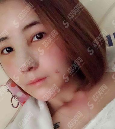 韩国korea整形医院靠谱吗?鼻部手术做的如何+术后恢复详情及整形价目表2021