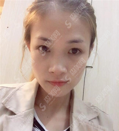 合肥901医院的自体脂肪隆鼻整形项目的价格贵吗?合肥901医院的自体脂肪隆鼻案例分享+整形价目表2021