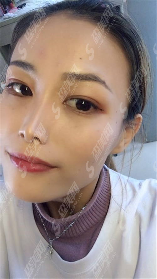 合肥901医院的自体脂肪隆鼻整形项目的价格贵吗?合肥901医院的自体脂肪隆鼻案例分享+整形价目表2021