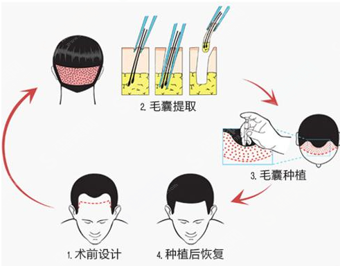 造成脱发的原因有哪些?植发的毛囊如何计算?附植发价目表2021
