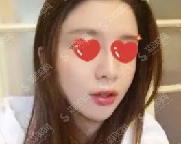 长沙伟恩整形医院假体鼻部手术案例分享,附鼻部手术术后的事项及鼻部手术的术后恢复历程+整形价目表