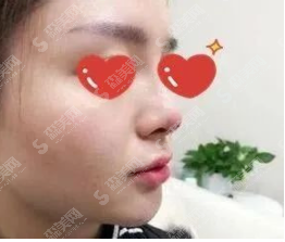 长沙伟恩整形医院假体鼻部手术案例分享,附鼻部手术术后的事项及鼻部手术的术后恢复历程+整形价目表