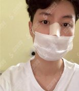 广州曙光美容医院价目表2021，内含耳软骨隆鼻案例分享