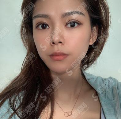 深圳北大双眼皮价目表2021，内含双眼皮整形案例＋术后恢复情况