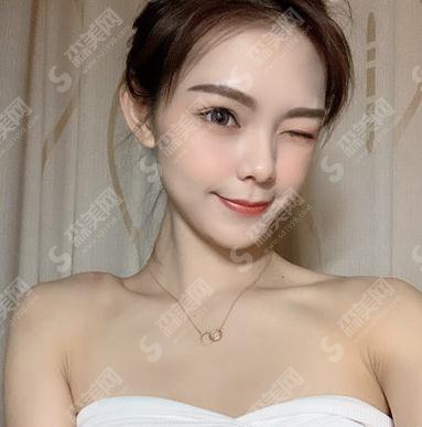 深圳北大双眼皮价目表2021，内含双眼皮整形案例＋术后恢复情况