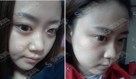 柏盛医疗整形是正规的整形医院吗?南京柏盛整形的隆鼻整形/医院介绍/较新整形价目表