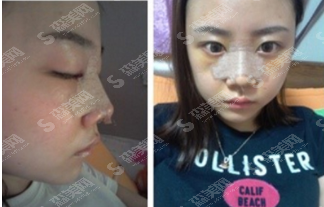 柏盛医疗整形是正规的整形医院吗?南京柏盛整形的隆鼻整形/医院介绍/较新整形价目表