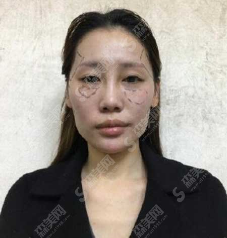 沈阳名流整形医院怎么样?面部填充注射案例分享/术后果/价目表2021