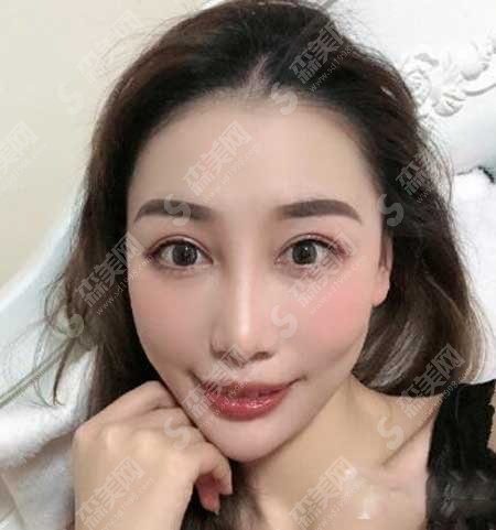 沈阳名流整形医院怎么样?面部填充注射案例分享/术后果/价目表2021