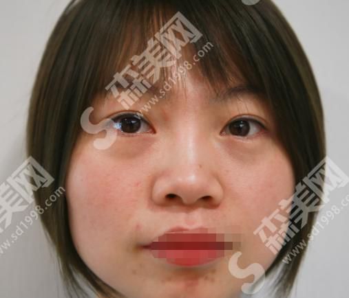 南京整形的医生怎么样？附医师介绍及双眼皮真人案例分享