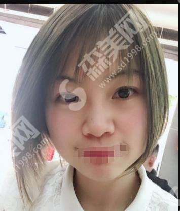 南京整形的医生怎么样？附医师介绍及双眼皮真人案例分享