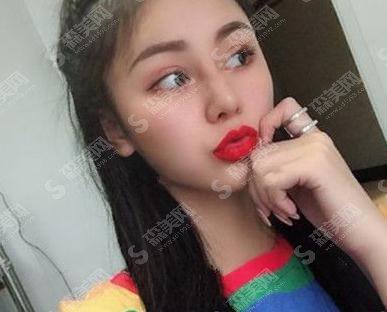 郑大一附院点阵激光多少钱?祛斑案例分享+详情恢复