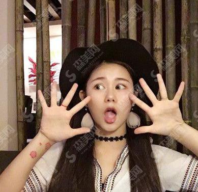 郑大一附院点阵激光多少钱?祛斑案例分享+详情恢复