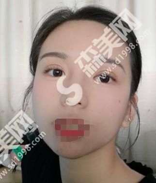 哈尔滨211整形医院做的双眼皮果自然吗？附医师介绍案例分享