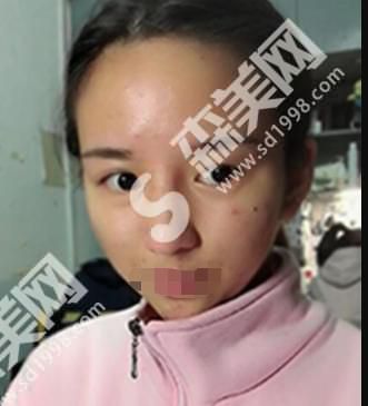 哈尔滨211整形医院做的双眼皮果自然吗？附医师介绍案例分享