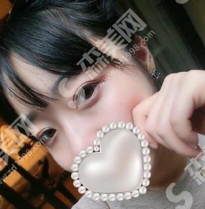 厦门第一医院整形美容科整形技术如何?值得推荐吗?看一看双眼皮案例前后对比图