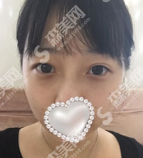 厦门第一医院整形美容科整形技术如何?值得推荐吗?看一看双眼皮案例前后对比图