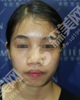 广州海峡整形医院做的整形果怎么样？附真人隆鼻案例分享