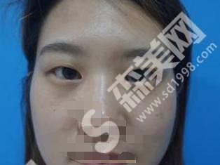西安美莱医院双眼皮怎么样？附医生简介及恢复过程一览