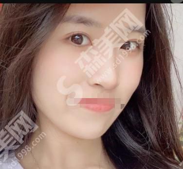 张德友做的双眼皮果如何？现在医生在哪家医院坐诊？