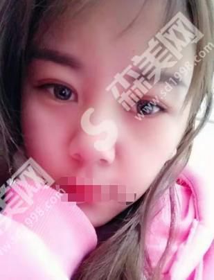 菏泽市立医院盖红宇的技术怎么样?附双眼皮案例分享及医生介绍