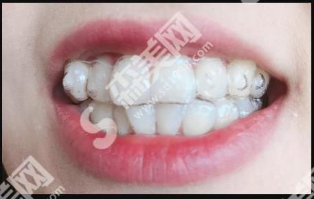 广大口腔医院做的牙齿矫正怎么样?附医师介绍及案例分享