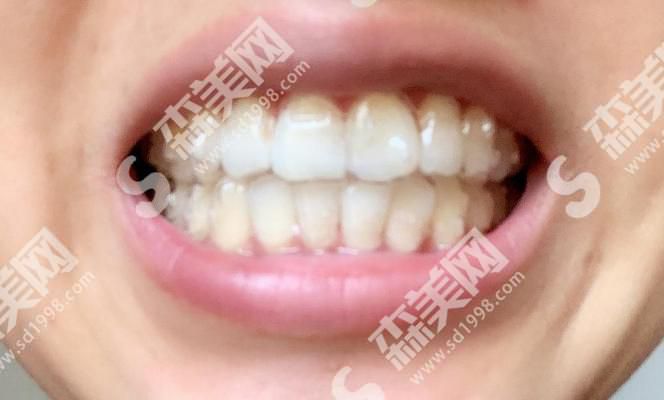 广大口腔医院做的牙齿矫正怎么样?附医师介绍及案例分享