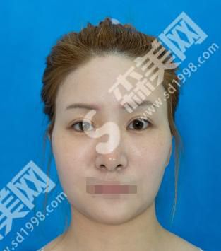 潍坊医学院附属医院卢小生做的双眼皮如何?附医师介绍及案例分享