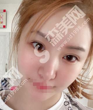 潍坊医学院附属医院卢小生做的双眼皮如何?附医师介绍及案例分享