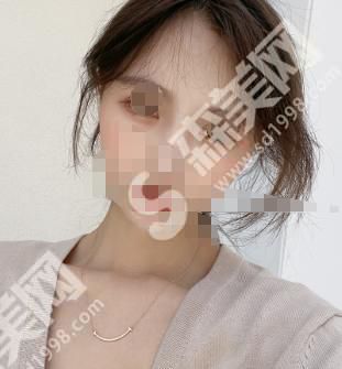 郑州华山整形可靠吗？祛眼袋案例果图对比