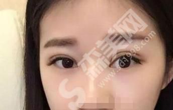 北京英煌医院双眼皮果恢复对比图分享，看看果好吗？
