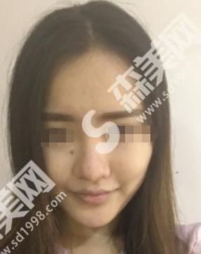 湛江华美整形医院做的整形果怎么样？附隆鼻真人分享+医生介绍