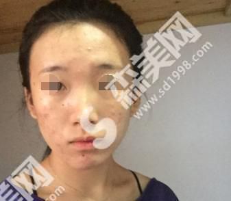 恩喜整形医院的口碑怎么样?恩喜整形医院医生有哪些?恩喜整形医院激光祛斑前后对比图