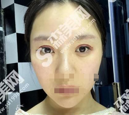 成都娇点整形美容医院是正规医院吗？医院双眼皮案例前后对比图+医生简介