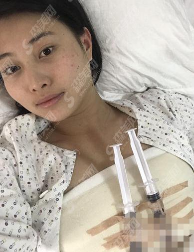 郑大一附院医学美容中心假体隆胸果好吗？果图公布_价格参考