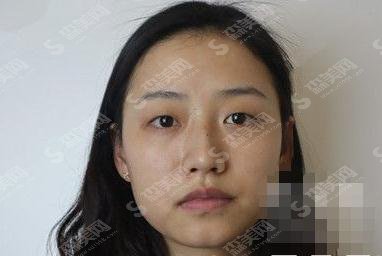 长海医院埋线双眼皮多少钱?价格查询+双眼皮案例分享图片