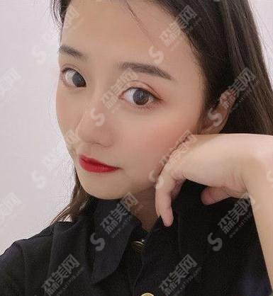 长海医院埋线双眼皮多少钱?价格查询+双眼皮案例分享图片