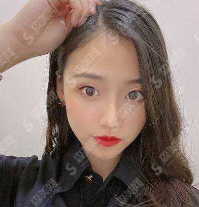 长海医院埋线双眼皮多少钱?价格查询+双眼皮案例分享图片