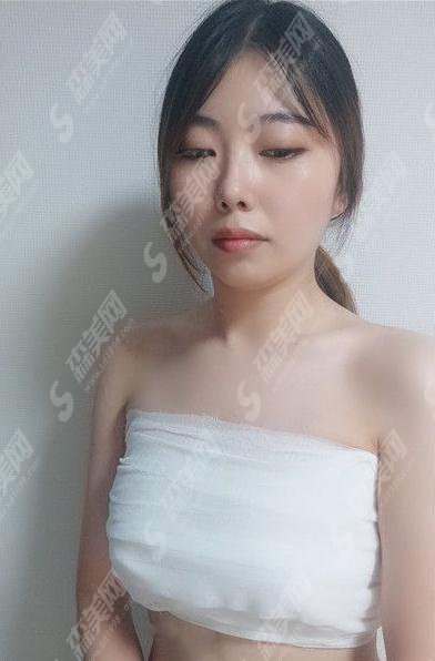 山大一院整形美容科脂肪隆胸怎么样?价格查询及脂肪隆胸案例对比图分享