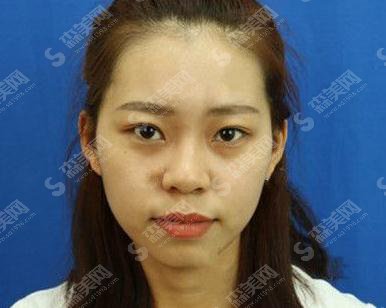 哪家医院做双眼皮较好?上海华美双眼皮案例公布+价格表一览