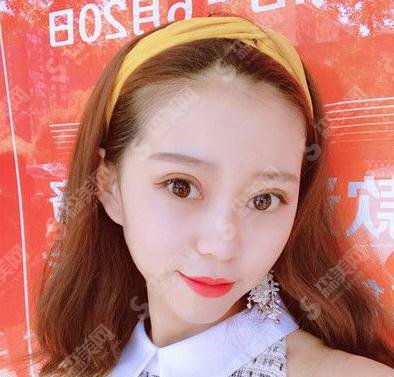 哪家医院做双眼皮较好?上海华美双眼皮案例公布+价格表一览