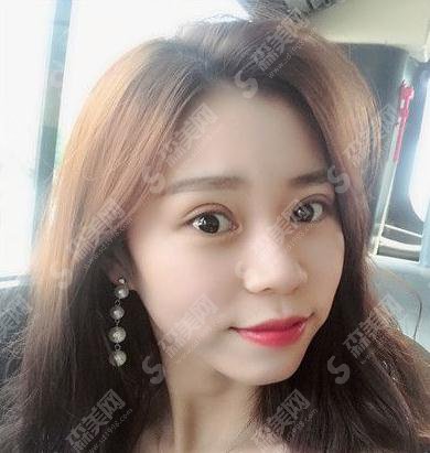 哪家医院做双眼皮较好?上海华美双眼皮案例公布+价格表一览