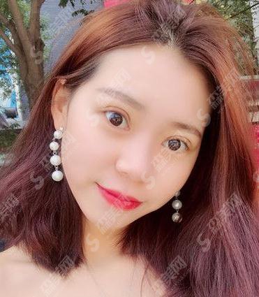 哪家医院做双眼皮较好?上海华美双眼皮案例公布+价格表一览