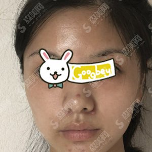 杭州市三医院光子嫩肤怎么样?术后案例果图分享@附较新的整形价目表参考