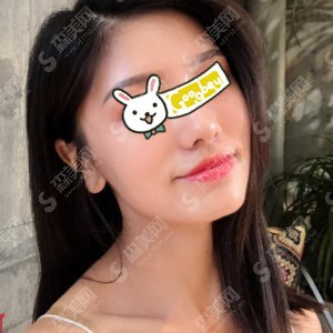 杭州市三医院光子嫩肤怎么样?术后案例果图分享@附较新的整形价目表参考