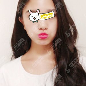 杭州市三医院光子嫩肤怎么样?术后案例果图分享@附较新的整形价目表参考