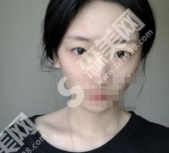 宜兴人民医院整形美容科靠谱吗？附医生介绍及双眼皮案例分享