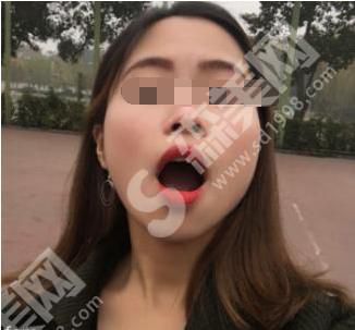 广大口腔医院的口碑如何？看看医院的牙齿矫正果如何吧！